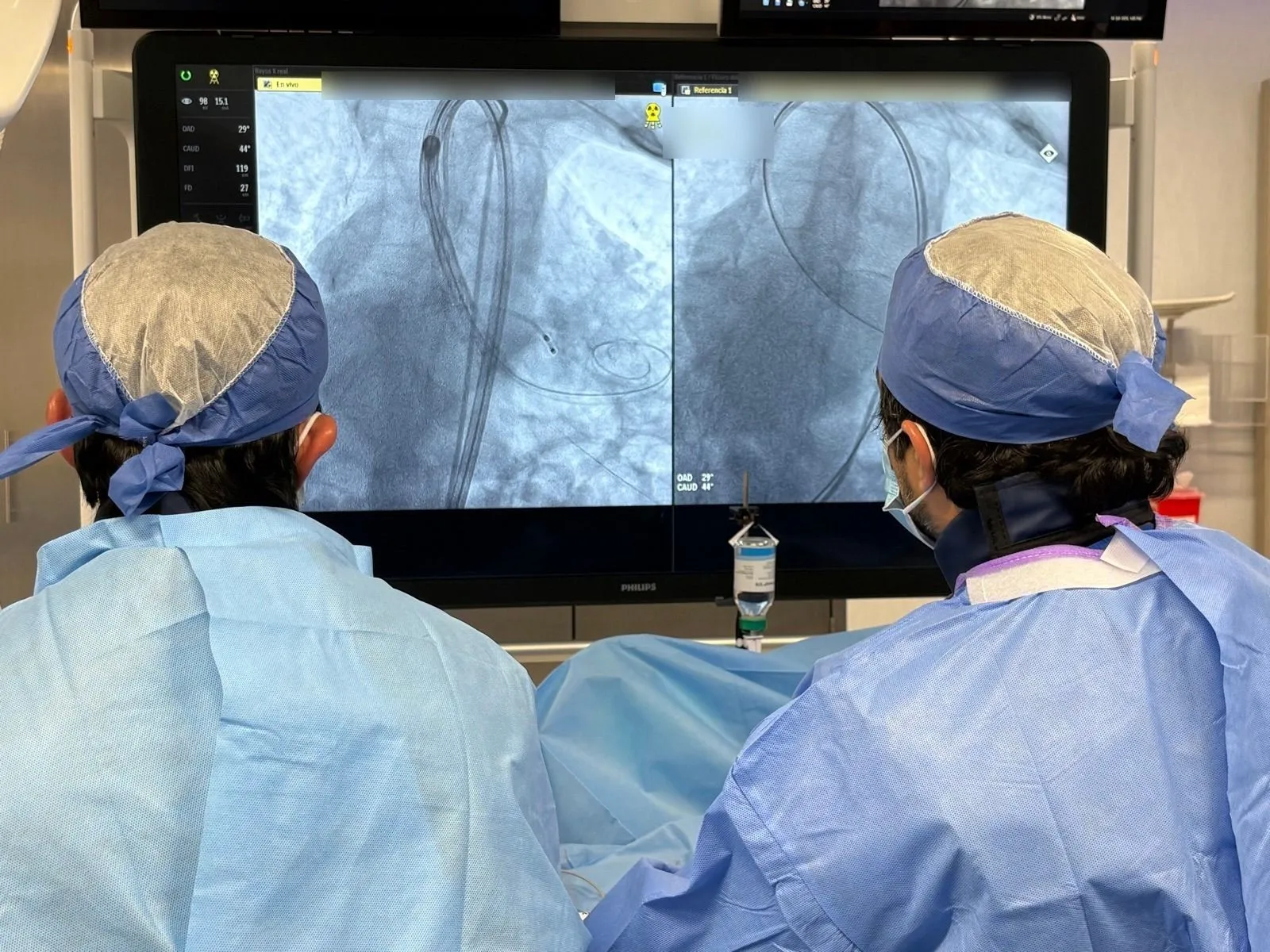 Dos operadores guían el implante frente al monitor de fluoroscopia en la sala de hemodinamia
